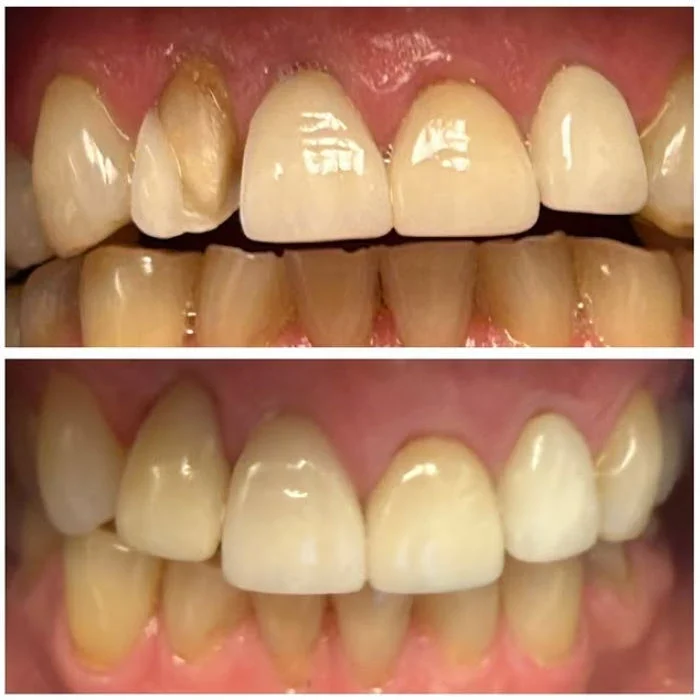 Dental Work Case 2 - Full Mouth Aesthetic Rehabilitation